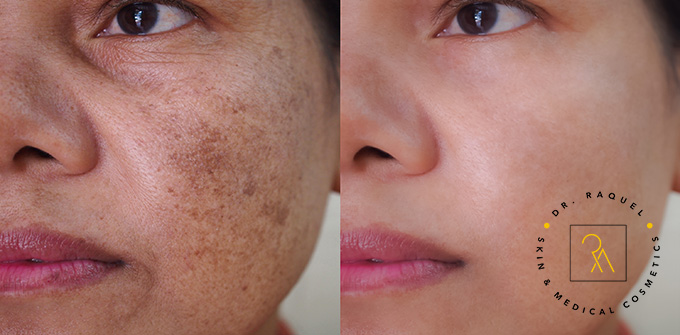 Melasma causes and treatments