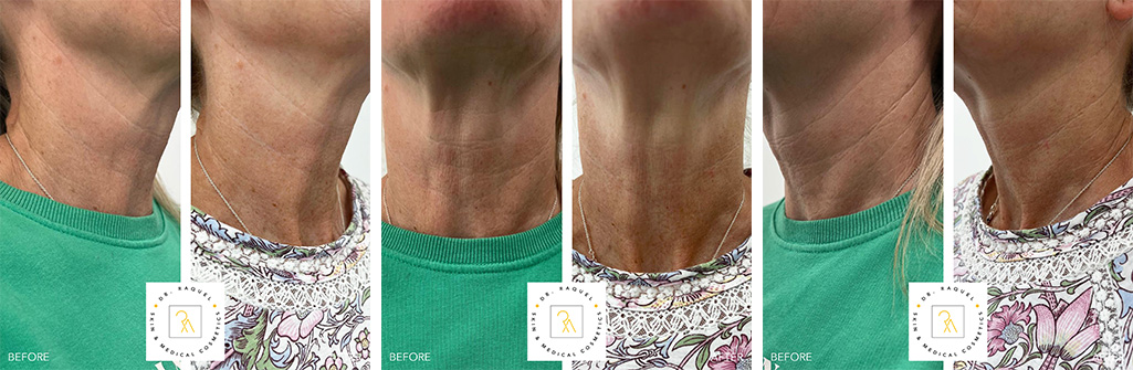Why the Neck Gives Away Your Age — Anti-Wrinkle Treatments Can Help Doctor led skin and medical aesthetics clinic